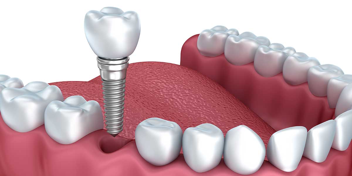 Dantų implantacija